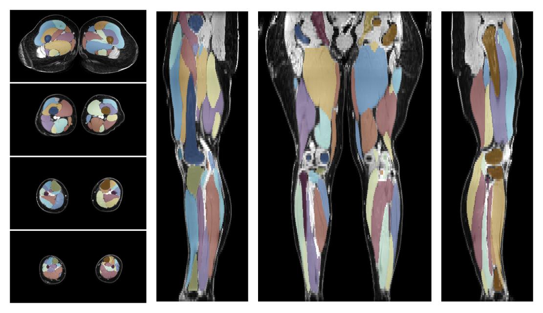 Overlay of automated muscle segmentation labels on dixon water image.